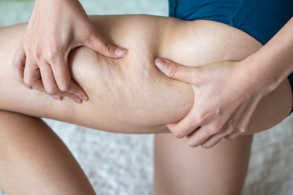 What type of cellulite is called?