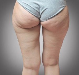 Causes of cellulite